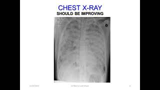 Dr Manny VV ECMO Learn shop part 7: Weaning from V-V ECMO