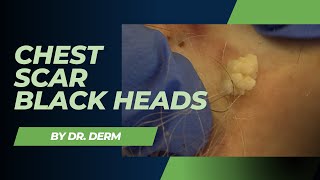 Chest Scar Blackheads | Dr. Derm