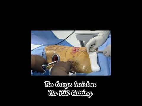 Lung Surgery Without Big Cuts? This Is VATS