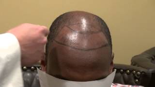 preview picture of video 'African American Bald Hair Loss Transplant Restoration Surgery Dr. Diep Los Gatos Near San Jose CA'