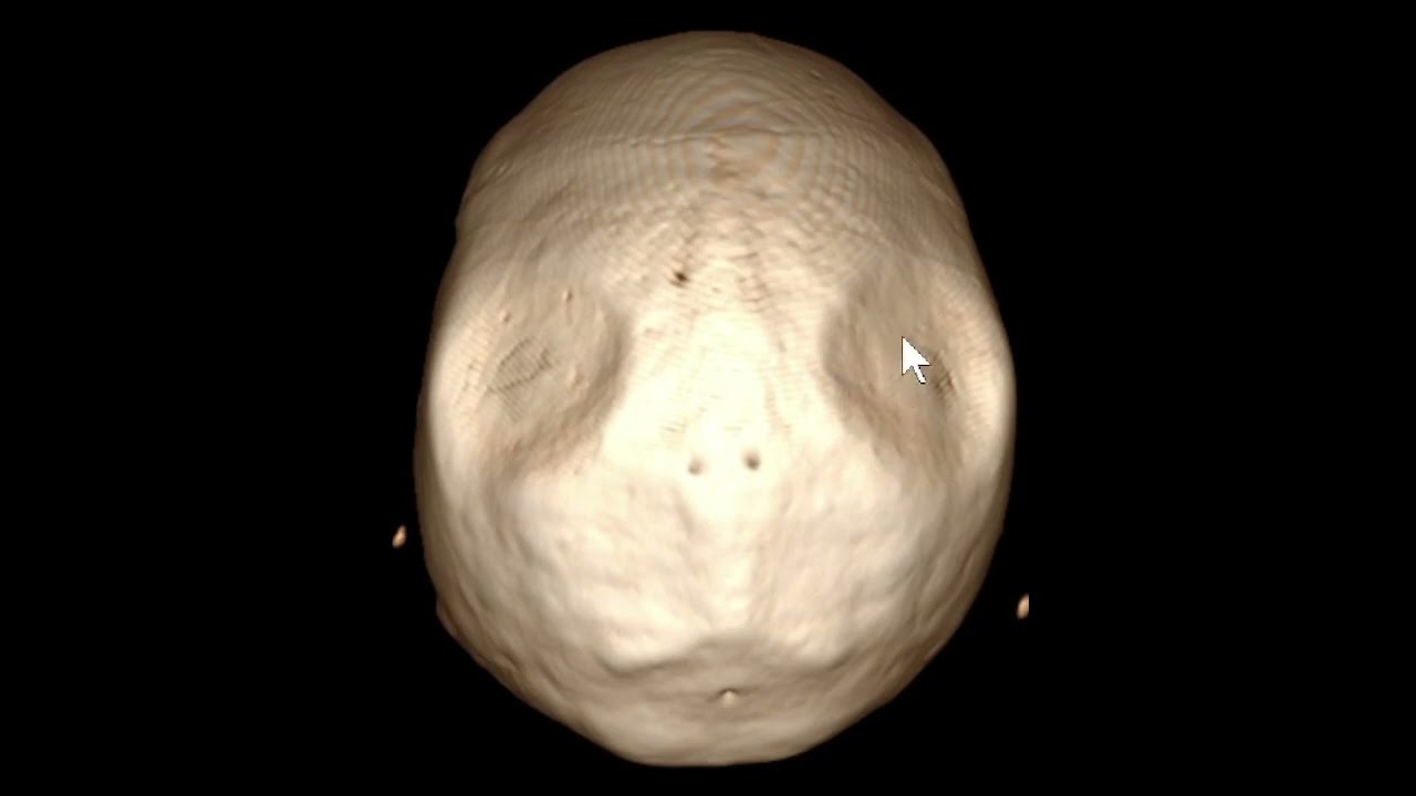 Afilamento ósseo biparietal