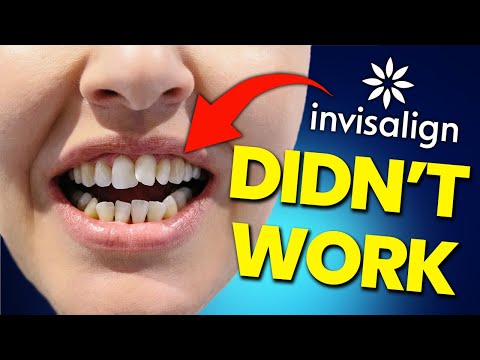 The BRUTAL TRUTH about Invisalign...watch BEFORE you buy