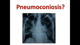 Pneumoconiosis on Chest X-Ray and CT Scan Chest