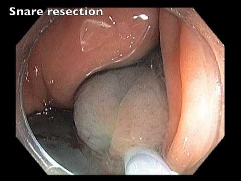 Transverse Colon Mucosal EMR