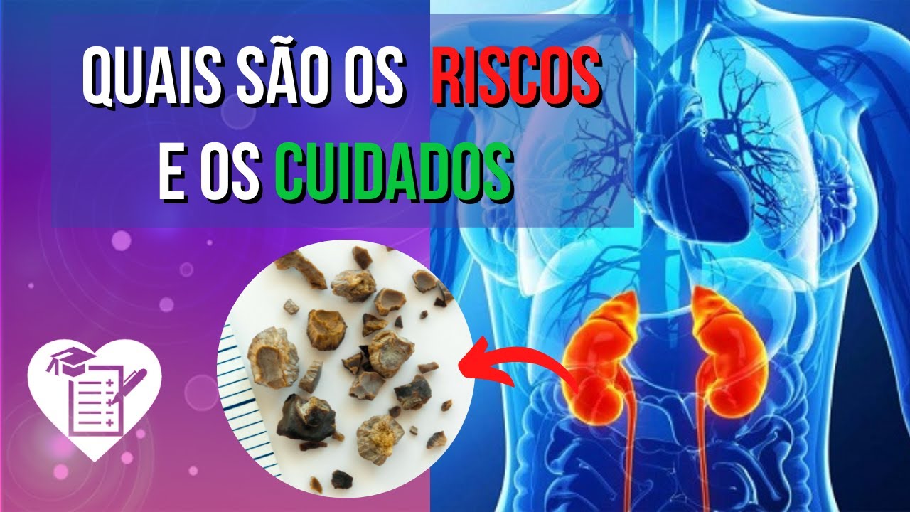 CÁLCULO RENAL - O que é, Sintomas e Tratamento