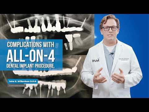 Complications with all-on-4 dental implant procedure.