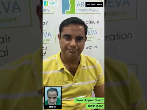 DHI Hair Transplant Results That Inspire: A Real Success Story from India