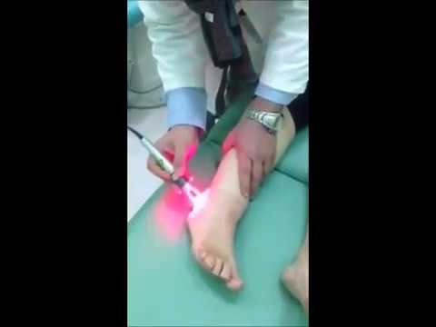 Instabilità piede dellarticolazione Come costruire i muscoli profondi della schiena con osteocondrosi