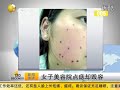 點「痣」成金？弄巧成拙變成大花臉