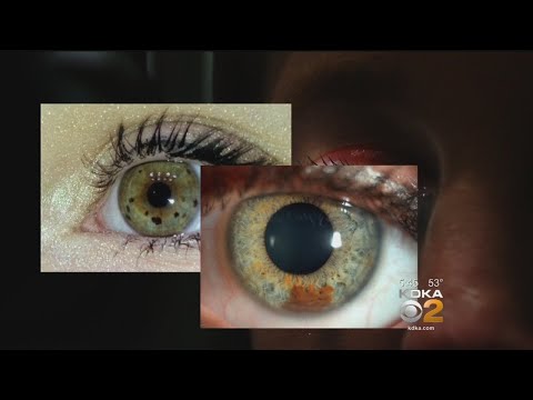 New Study Looks At Possible Relationship Between Eye Freckles And Melanoma