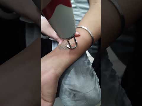 Laser Tattoo Removal | 5 Sessions Before & After Result