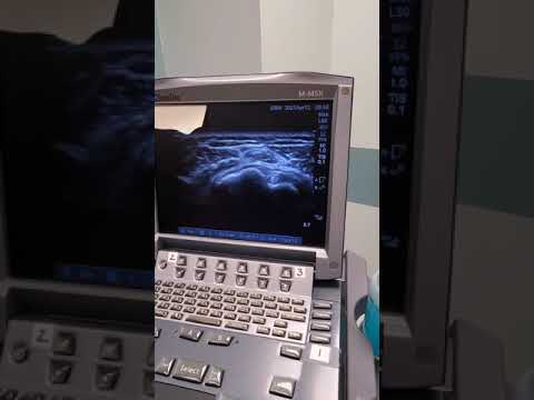 Ultrasound Guided Subacromial Shoulder injection for impingement syndrome.