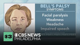 What is Bell's palsy? What to know about symptoms and treatments