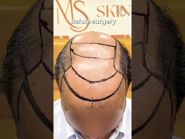 Hair Transplant Delhi