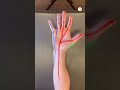 Numbness and tingling in the pinky finger is caused by THIS
