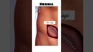 Download lagu Hernia 3d animation| How Hernia is treated| #shorts #healtheducation #hernia #medicalanimation #3d mp3 Download lagu Hernia 3d animation| How Hernia is treated| #shorts #healtheducation #hernia #medicalanimation #3d mp3