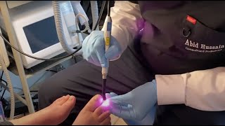 Cure Fungus Nails Quickly with Laser Treatment UK