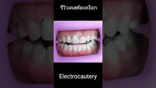 ยิ้มเห็นเหงือกเยอะ  ก็สามารถสวยได้ง่ายๆด้วยการตัดเหงือกนะคะ รีวิวเคสตัดเหงือก gummy smile