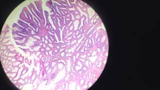 Anatomía Patológica - Adenoma Tubular con Displasia de bajo grado