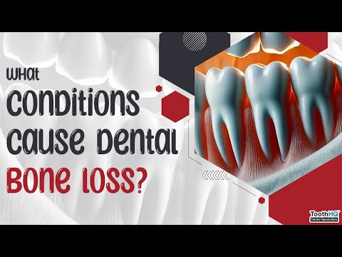 What conditions cause dental bone loss?