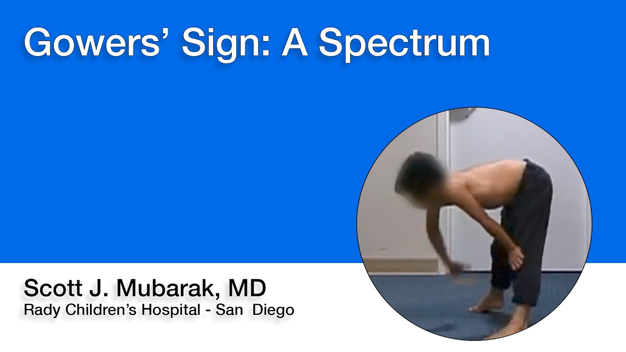 Gowers Sign: A Spectrum – Scott J. Mubarak, MD