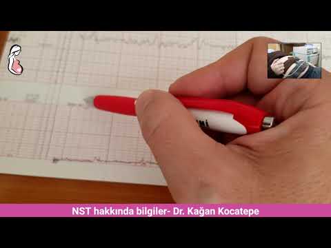 NST nasıl yorumlanır? Doğum sancısı-yalancı Braxton-Hicks rahim kasılmaları ve bebek kalp atışları