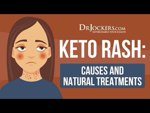 Keto Rash:  Causes and Natural Treatments