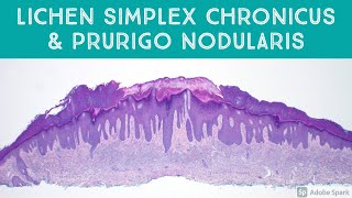 Lichen Simplex Chronicus & Prurigo Nodularis: The "Lichen" Every Pathologist Should Know