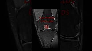 Artrosis de RODILLA vista en resonancia