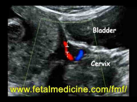 Fetal Medicine Foundation - Preeclampsia