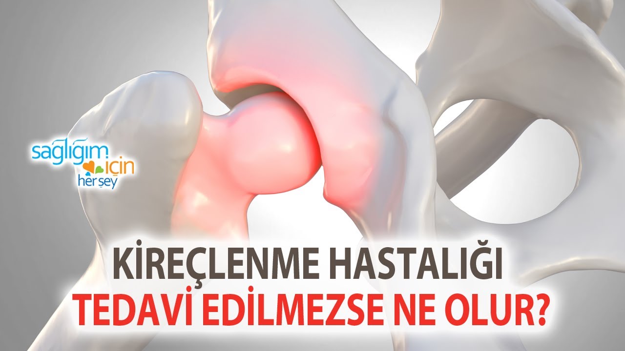 Kireçlenme Hastalığı Tedavi Edilmezse Ne Olur?