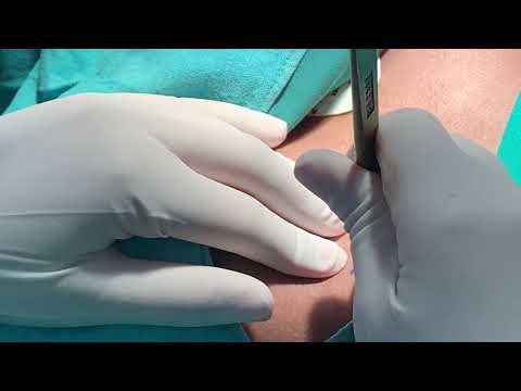 Cartilaginous Rib Is The Best Material For Cleft And Other Reconstructive Nose Surgeries
