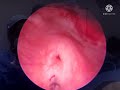 Endoscopic treatment of VUR in infant by @Pediatric-Urologist