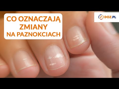 Co wygląd paznokci mówi o Twoim zdrowiu?