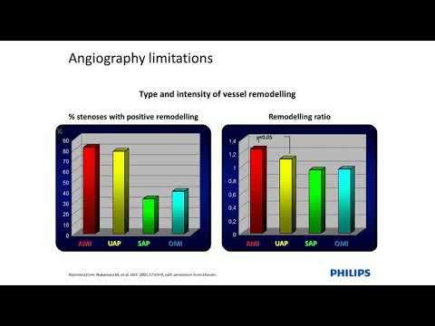 Use of IVUS Imaging in PCI on Left Main Coronary Artery Disease - Prof. Adrian Banning