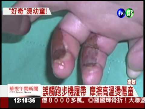 跑步機履帶發熱 幼童誤觸燙傷