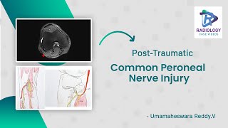 Common Peroneal Nerve Injury#Foot drop: MRI | Umamaheswara Reddy.V