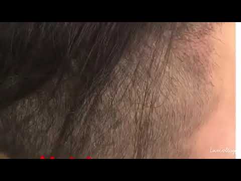 Sac Simulasyonu & Sac Estetigi Hair Inn Mine TOKER Fark ile #16