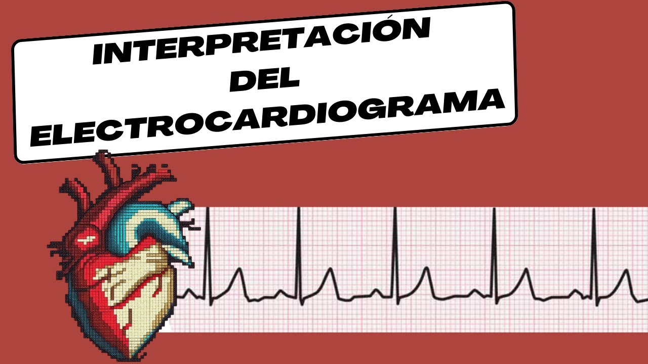 Interpretación del Electrocardiograma