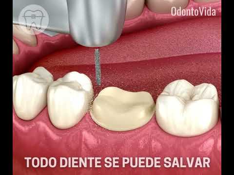 TODO DIENTE SE PUEDE SALVAR