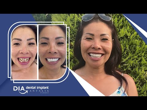 Happy Smiles Thı Kım Phuoung | Dental Implant Antalia