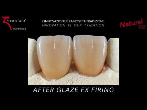 Stratificazione Prismatic Dentin Nunzio Rosa