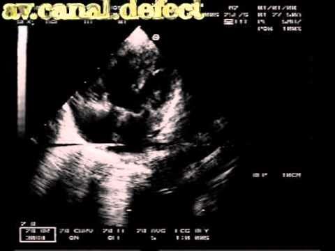 Atrioventricular Canal With Small Ostium Secundum Atrial Septal Defect