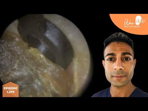 1,299 - Ear Hook & Jobson Horne Ear Wax Removal
