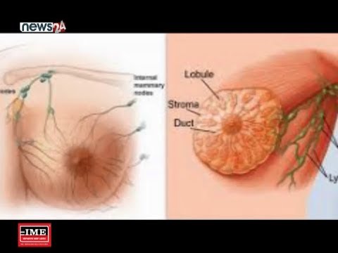 एक लाख महिलामध्ये २१.८ मा स्तन क्यान्सर  - NEWS24 TV