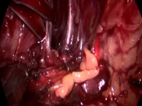 Umbilical Single-Port Laparoscopic Radical Prostatectomy With a New Duo Rotate System