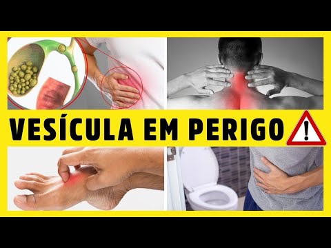 12 SINAIS  de que sua VESÍCULA BILIAR está com PROBLEMAS (PEDRAS NA VESÍCULA) Dr Alain Dutra