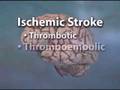 Stroke