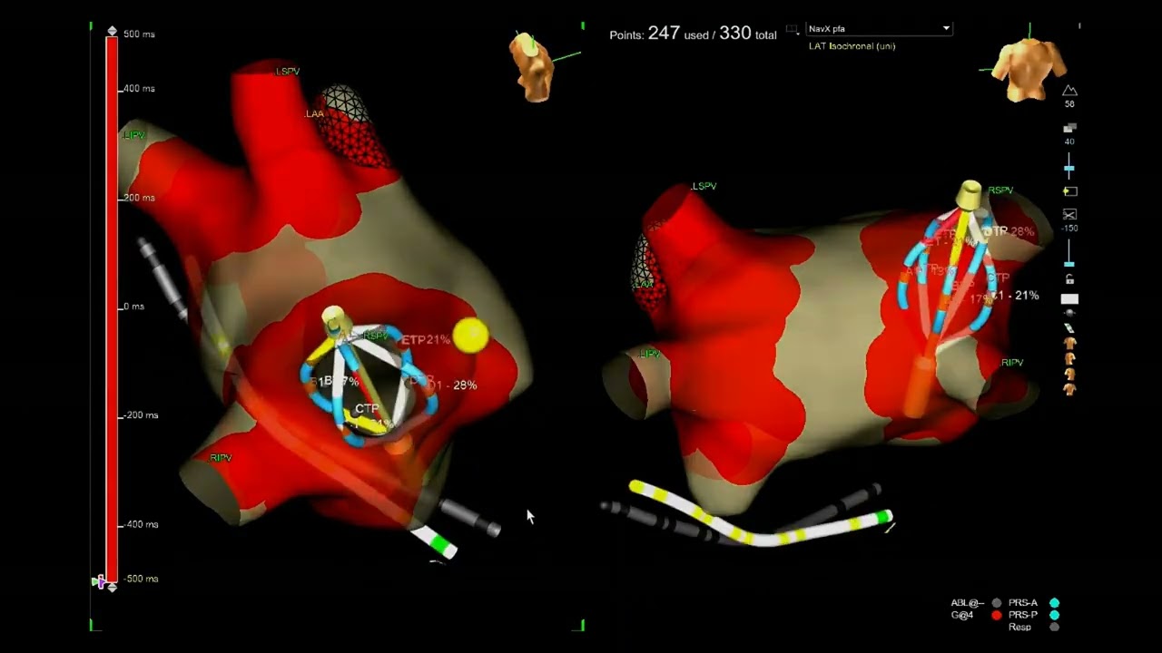 AFib Management