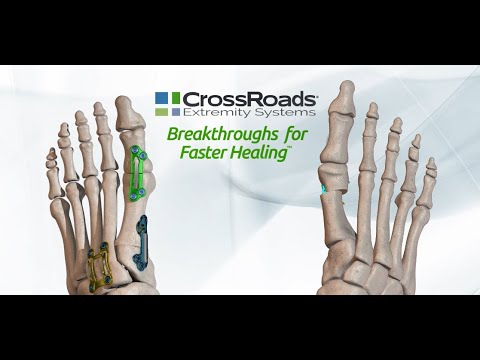 The First Ray by CrossRoads™ Animation - Now Featuring the dynaMet™ Lesser TMT Fusion System!